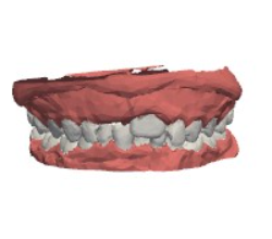 occlusionJawModel